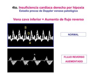 4to.  Insuficiencia cardíaca derecha por hipoxia   Estadio precoz de Doppler venoso patológico Vena cava inferior = Aumento de flujo reverso NORMAL FLUJO REVERSO AUEMENTADO 