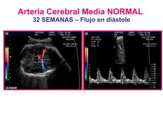 Arteria Cerebral Media NORMAL   32 SEMANAS – Flujo en diástole 