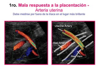 1ro.  Mala respuesta a la placentación -  Arteria uterina Debe medirse por fuera de la ilíaca en el lugar más brillante 