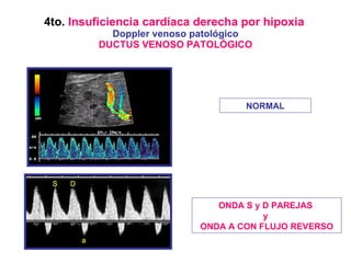 4to.  Insuficiencia cardíaca derecha por hipoxia   Doppler venoso patológico DUCTUS VENOSO PATOLÓGICO NORMAL ONDA S y D PA...