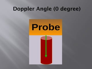 Doppler Angle (0 degree)
 