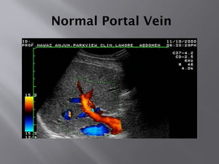 Normal Portal Vein
 