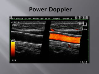 Power Doppler
 
