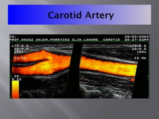 Carotid Artery
 