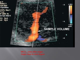 MCA…soon after origin
Angle close to zero degree
 