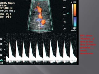 PSV above
70cm/sec…if
seen in less
than 30 weeks
gestation…..
needs
transfusion.
 