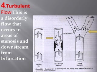 4.Turbulent
Flow-This is
a disorderly
flow that
occurs in
areas of
stenosis and
downstream
from
bifurcation
 