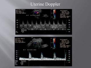 Uterine Doppler
 