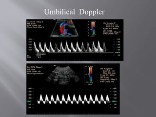 Umbilical Doppler
 