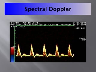 Spectral Doppler
 