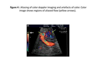 figure 4 : Aliasing of color doppler imaging and artefacts of color. Color
image shows regions of aliased flow (yellow arrows).
 