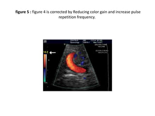 figure 5 : figure 4 is corrected by Reducing color gain and increase pulse
repetition frequency.
 