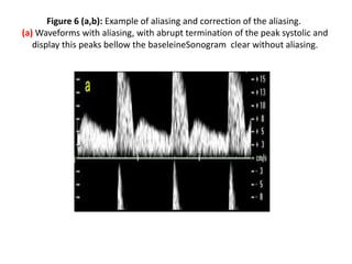 Figure 6 (a,b): Example of aliasing and correction of the aliasing.
(a) Waveforms with aliasing, with abrupt termination of the peak systolic and
display this peaks bellow the baseleineSonogram clear without aliasing.
 