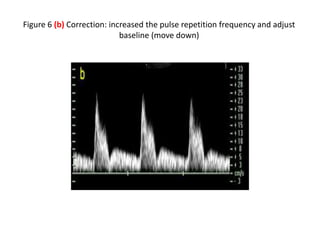 Figure 6 (b) Correction: increased the pulse repetition frequency and adjust
baseline (move down)
 