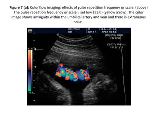 Figure 7 (a): Color flow imaging: effects of pulse repetition frequency or scale. (above)
The pulse repetition frequency or scale is set low {11.0} (yellow arrow). The color
image shows ambiguity within the umbilical artery and vein and there is extraneous
noise.
 