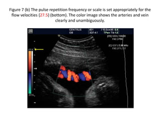 Figure 7 (b) The pulse repetition frequency or scale is set appropriately for the
flow velocities {27.5} (bottom). The color image shows the arteries and vein
clearly and unambiguously.
 