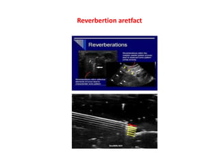 Reverbertion aretfact
 