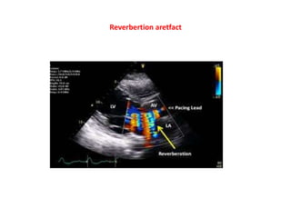 Reverbertion aretfact
 