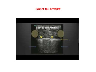Comet tail artefact
 