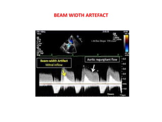 BEAM WIDTH ARTEFACT
 