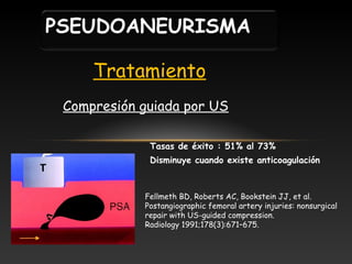 PSEUDOANEURISMA
Tratamiento
Compresión guiada por US
Tasas de éxito : 51% al 73%
Disminuye cuando existe anticoagulación

Fellmeth BD, Roberts AC, Bookstein JJ, et al.
Postangiographic femoral artery injuries: nonsurgical
repair with US-guided compression.
Radiology 1991;178(3):671–675.

 