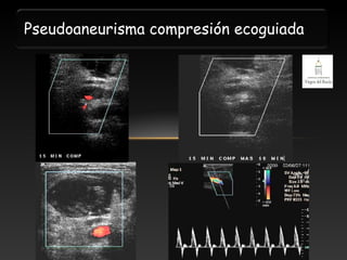 Pseudoaneurisma compresión ecoguiada

 