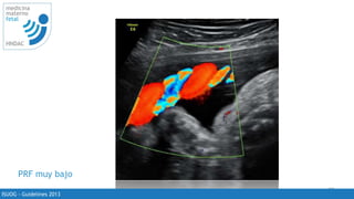 22
medicina
materno
fetal
HNDAC
erencia de la
a dependiendo
onde se toma la
el doppler.
recomienda
sa libre de
omienda tomar
cerca del feto en
s múltiples
ISUOG - Guidelines 2013
PRF muy bajo
 