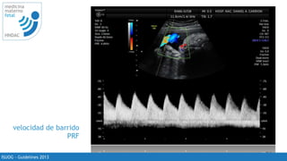 24
medicina
materno
fetal
HNDAC
ISUOG - Guidelines 2013
velocidad de barrido
PRF
 