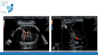 52
medicina
materno
fetal
HNDAC
 