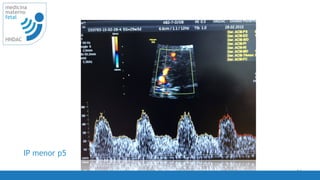 56
medicina
materno
fetal
HNDAC
IP menor p5
 