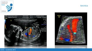 tecnica del ductus arterioso
• seguir la arteria umbilical hasta
su unión aparente con la vena
cava
• en un plano oblicuo del
abdomen se debe lograr
visualizar
• colocar el doppler y buscar la
zona de mayor velocidad
• de buscarse lograr una
insonacion en 0 º
• la velocidad en mayor 50 cm/s
en el II y III trimestre. 66
ISUOG - Guidelines 2013
medicina
materno
fetal
HNDAC
tecnica
 