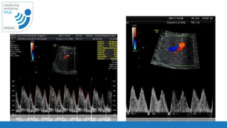 68
medicina
materno
fetal
HNDAC
 