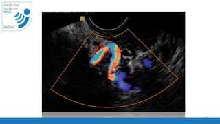 • buscar vaso ascendente.
73
medicina
materno
fetal
HNDAC
 