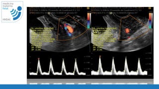 74
medicina
materno
fetal
HNDAC
 