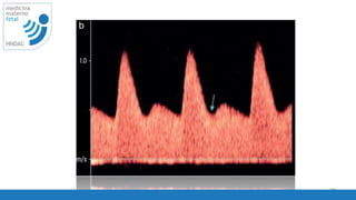 technique, the
he paracervical
e carried out in
minal technique.
Figure 2 Waveforms from uterine artery obtained trans- 78
medicina
materno
fetal
HNDAC
 