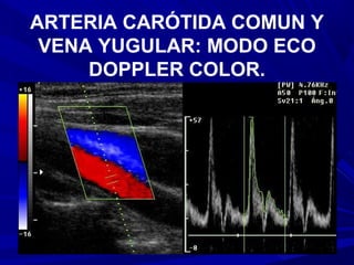 ARTERIA CARÓTIDA COMUN Y
 VENA YUGULAR: MODO ECO
     DOPPLER COLOR.
 