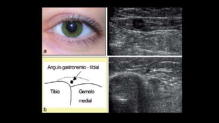 Figura 4. Safena interna en espacio safeno en el muslo.
una later
se denom
el 40% d
del muslo
la unión s
nodo bas
fácilment
con los v
interna q
Es muy i
cialmente
post-ope
 