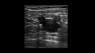 estación.
la arcada inguinal, con un
de la unión safeno-femoral
. 2). Se evalúa el reﬂujo a
al común, la vena femoral y
e maniobras de Valsalva con
5).
ormar si existen aﬂuentes al
o no tortuosas y si son o no
e, hay que consignar si el
minal) o si se encuentra en
y 7).
iámetro de la vena safena
en los que presentan golfos
a entre el borde anterior de
dad del ostium.
se evalúa el reﬂujo en la
magna en el tercio superior,
insuﬁcientes se debe deﬁ-
a el trayecto insuﬁciente, y
una o más epifasciales dila-
qué localización y dónde se
VSM
VFC
Arteria femoral común
 