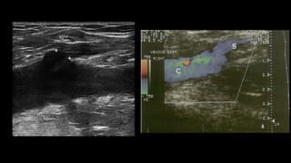ARTICLE IN PRESSRARD-60; No. of Pages 8
Doppler de miembros inferiores en la insuﬁciencia venosa 5
VSM
VFC
Figura 8 Corte longitudinal a nivel del ostium, donde se debe
hacer la medición del diámetro de la VSM.
- Se debe mencionar y evaluar la existencia de venas vari-
cosas que no tengan relación con las safenas, así como
también hay que establecer cuál es su procedencia (por
ejemplo: vena pélvica), ya que la ligadura de las safenas
puede no ser necesaria16
.
En síntesis, el objetivo del examen es determinar el punto
de fuga, la presencia de venas epifasciales insuﬁcientes y el
punto de reentrada, indicando la existencia de perforantes
insuﬁcientes y su localización.
Parámetros a evaluar en el paciente
safenectomizado con tratamiento de termo
obliteración
1) Buscar si se evidencian tramos de safena e informar
dónde comienzan y terminan.
2) Es importante tener en cuenta que en la etapa posquirúr-
gica inmediata se pueden ver imágenes hiperecogénicas
en la luz de la vena, habitualmente secundarias al tra-
tamiento de termo obliteración con láser. Esto no debe
ser confundido con trombosis y tiene que ser informado
como safena termo-obliterada.
 