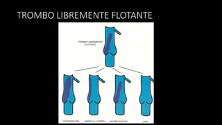 TROMBO	
  LIBREMENTE	
  FLOTANTE
 