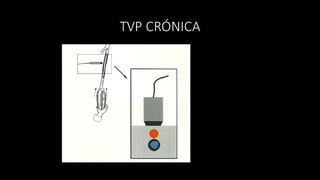 TVP	
  CRÓNICA
 