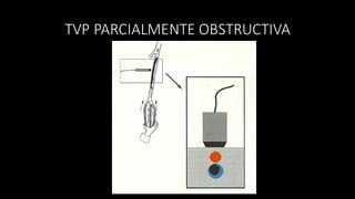TVP	
  PARCIALMENTE	
  OBSTRUCTIVA
 