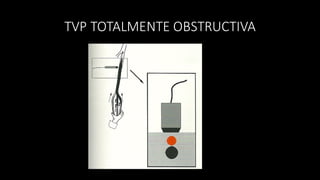 TVP	
  TOTALMENTE	
  OBSTRUCTIVA	
  
 