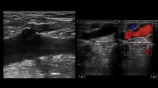 Doppler de miembros inferiores en la insuﬁciencia venosa 5
VSM
VFC
Figura 8 Corte longitudinal a nivel del ostium, donde se debe
hacer la medición del diámetro de la VSM.
- Se debe mencionar y evaluar la existencia de venas vari-
cosas que no tengan relación con las safenas, así como
también hay que establecer cuál es su procedencia (por
ejemplo: vena pélvica), ya que la ligadura de las safenas
puede no ser necesaria16
.
En síntesis, el objetivo del examen es determinar el punto
de fuga, la presencia de venas epifasciales insuﬁcientes y el
punto de reentrada, indicando la existencia de perforantes
insuﬁcientes y su localización.
Parámetros a evaluar en el paciente
safenectomizado con tratamiento de termo
obliteración
1) Buscar si se evidencian tramos de safena e informar
dónde comienzan y terminan.
2) Es importante tener en cuenta que en la etapa posquirúr-
gica inmediata se pueden ver imágenes hiperecogénicas
en la luz de la vena, habitualmente secundarias al tra-
tamiento de termo obliteración con láser. Esto no debe
ser confundido con trombosis y tiene que ser informado
como safena termo-obliterada.
ARTICLE+Model
RARD-60; No. of Pages 8
6
Vena perforante
Vena perforante insuficiente
HD
P
T
R
12,03,0
P
T
R
12,03,0
Figura 10 Vena perforante mayor de 3 mm con reﬂujo en el
 