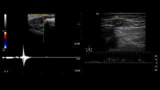 reverso ante las maniobras de Valsalva en la unión safena-
femoral (viraje de color rojo, en descanso a color azul, en
Valsalva).
+0,86
m/s
–0,864 s
m/s
–0,11
+0,11
Vena femoral VSM
Figura 5 Imagen que demuestra el cierre valvular correcto
sin reﬂujo en la VSM con el Doppler color y espectral.
Figura 7 Insuﬁciencia de la VSM en el tercio medio del m
ante las maniobras de Valsalva.
- Para examinar el eje de la VSP, con el paciente de e
das al operador, se realizan cortes transversales en la
posterior de la pantorrilla (de caudal a cefálico), vis
zando la vena safena parva y calculando el reﬂujo e
distintos niveles. Debe consignarse si es o no tortuo
a qué altura desemboca en la vena poplítea (si es
lo hace)15
, midiendo la distancia desde la planta del
A su vez, hay que evaluar la presencia o no de la
safena parva del muslo y, en caso de que esté prese
deﬁnir si esta es suﬁciente o insuﬁciente.
- A nivel del hueco poplíteo se busca la existencia de re
en la vena poplítea.
- Si se descubre insuﬁciencia de la VSP, también debe
indicar si el ostium está involucrado o si el reﬂujo se i
más caudalmente, si hay presencia de venas epifasc
dilatadas y los puntos de reentrada del ﬂujo.
- Es necesario explorar las venas tibiales posteriores, a
riores y peroneas.
ARTICLE IN PRESSRARD-60; No. of Pages 8
4 H. Berardi, A. Ciccioli
VSM
Izquierda
+ ,07
– ,07
m/s
+55,90
–54,98
cm/s
2
1
0
Vena femoral
VSM
5,3s
Figura 3 Doppler espectral con corte transversal evidencia
una VSM suﬁciente ante las maniobras de Valsalva.
HD
20
10
0
10
20
T
R
12,03,0
P
VSM
HD
Figura 6 Corte transversal de la VSM que muestra un aumento
de las velocidades anterógradas (por encima de la línea de
base), ante las maniobras de Valsalva.
 