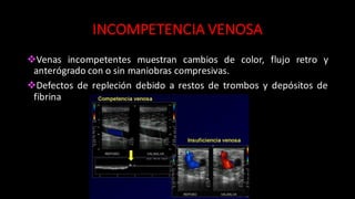 INCOMPETENCIA	
  VENOSA
vVenas incompetentes muestran cambios de color, flujo retro y
anterógrado con o sin maniobras compresivas.
vDefectos de repleción debido a restos de trombos y depósitos de
fibrina
 