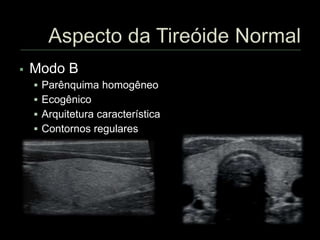  Modo B
 Parênquima homogêneo
 Ecogênico
 Arquitetura característica
 Contornos regulares
 