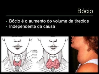  Bócio é o aumento do volume da tireóide
 Independente da causa
 
