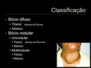  Bócio difuso
 Tóxico
 Atóxico
 Bócio nodular
 Uninodular
 Tóxico
 Atóxico
 Multinodular
 Tóxico
 Atóxico
doença de Graves
doença de Plummer
 