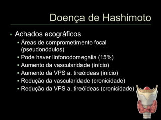  Achados ecográficos
 Áreas de comprometimento focal
(pseudonódulos)
 Pode haver linfonodomegalia (15%)
 Aumento da vascularidade (início)
 Aumento da VPS a. tireóideas (início)
 Redução da vascularidade (cronicidade)
 Redução da VPS a. tireóideas (cronicidade)
 